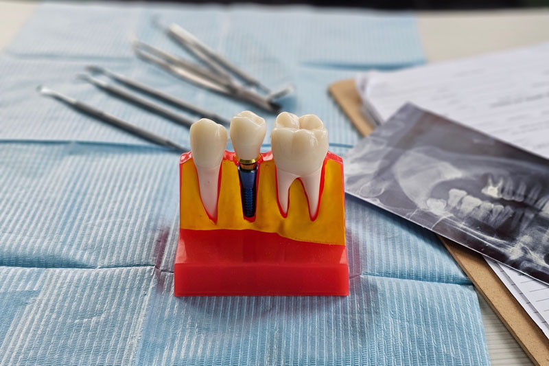 Doctor hold dental implant, artificial tooth roots into jaw, root canal of dental treatment, gum disease, teeth model for dentist studying about dentistry