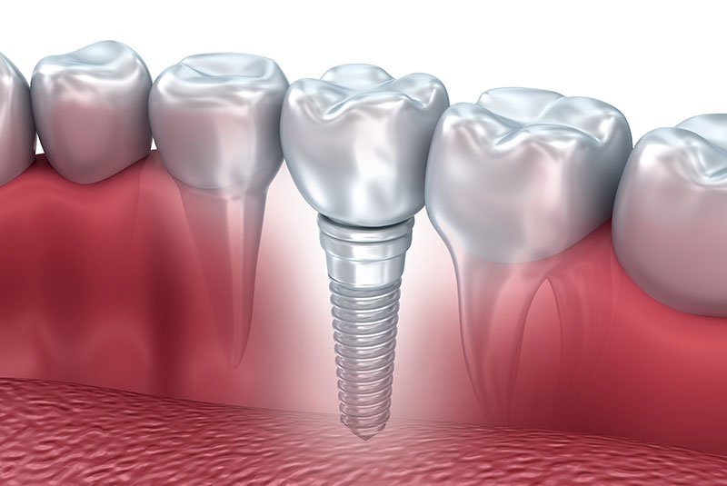 dental implant model