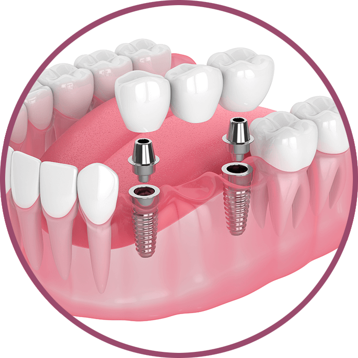 Dental Bridge