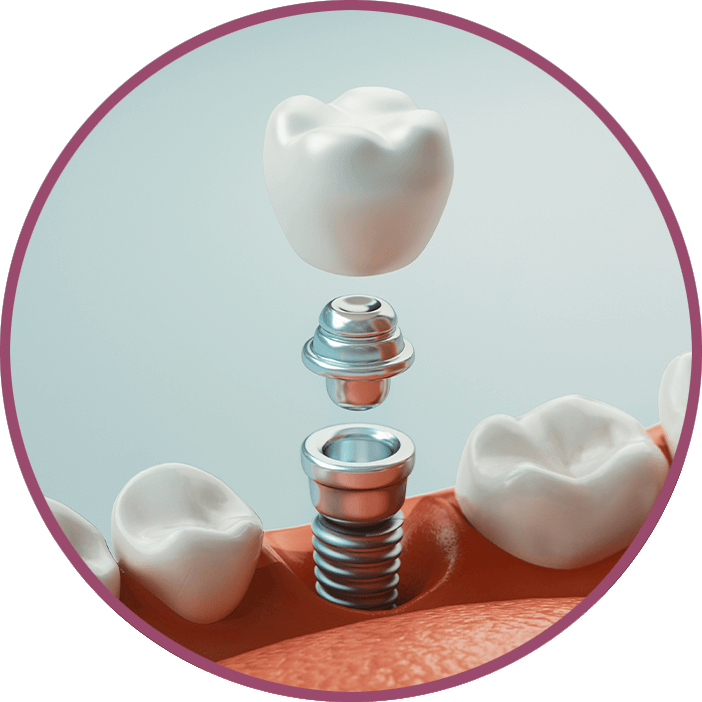Dental Implants