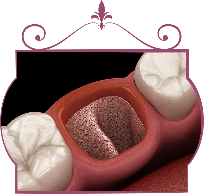 dry socket 3d