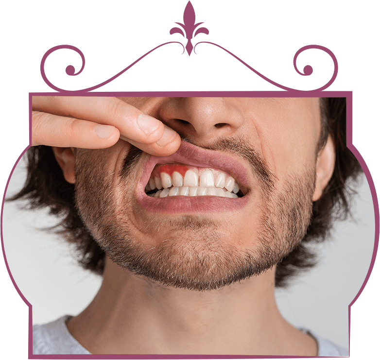 Gum disease