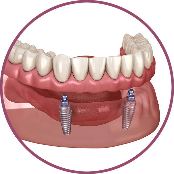 Implant Dentures