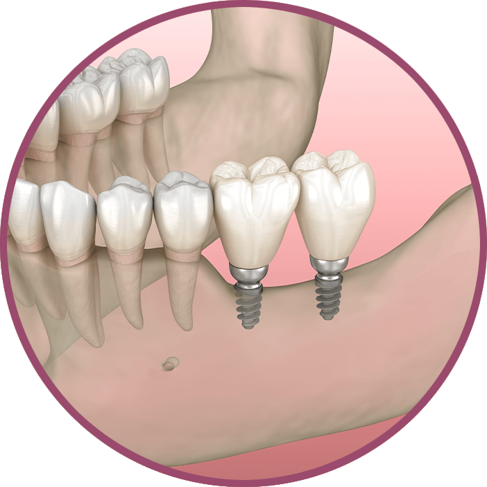 Small Implants