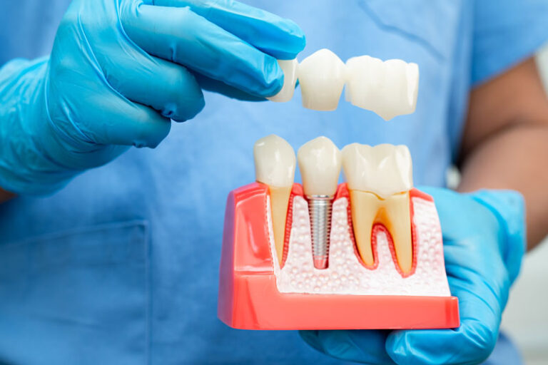 Dentist holding a dental implants model with blue gloves on in a dental office