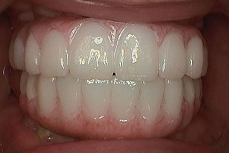 implant after