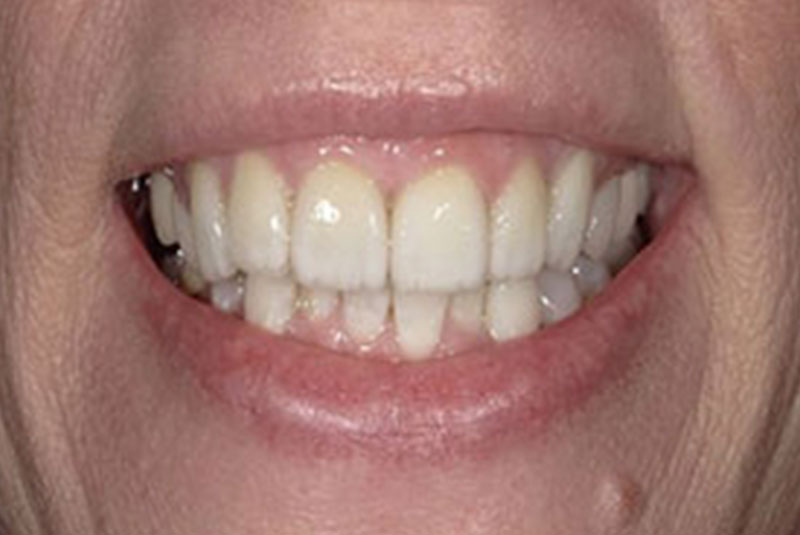 after veneer