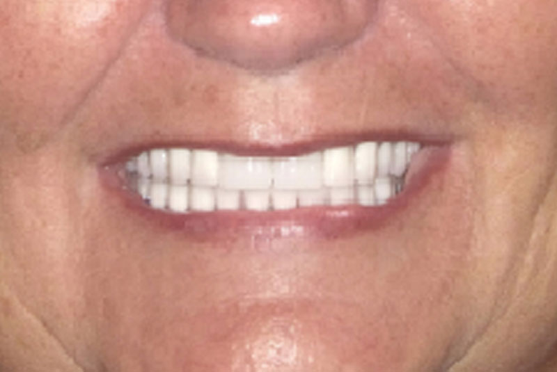 implant after