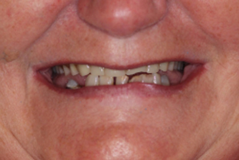 implant before