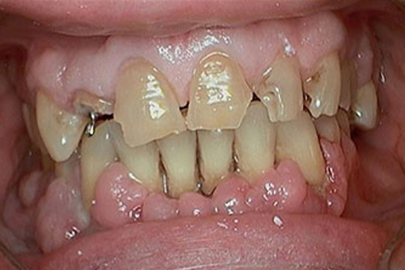 implant before