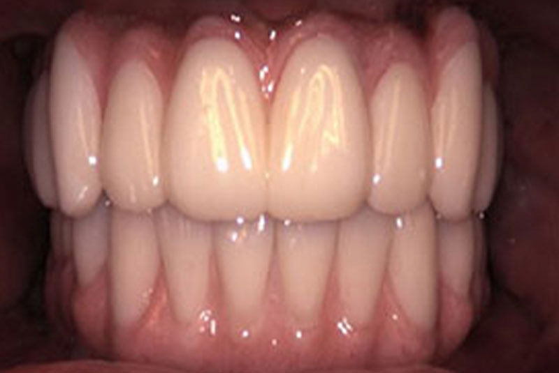 implant after