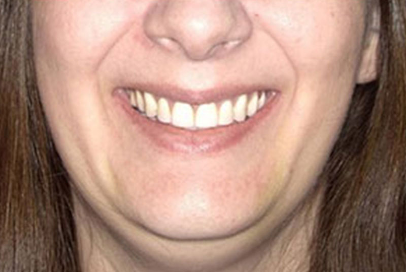 implant after