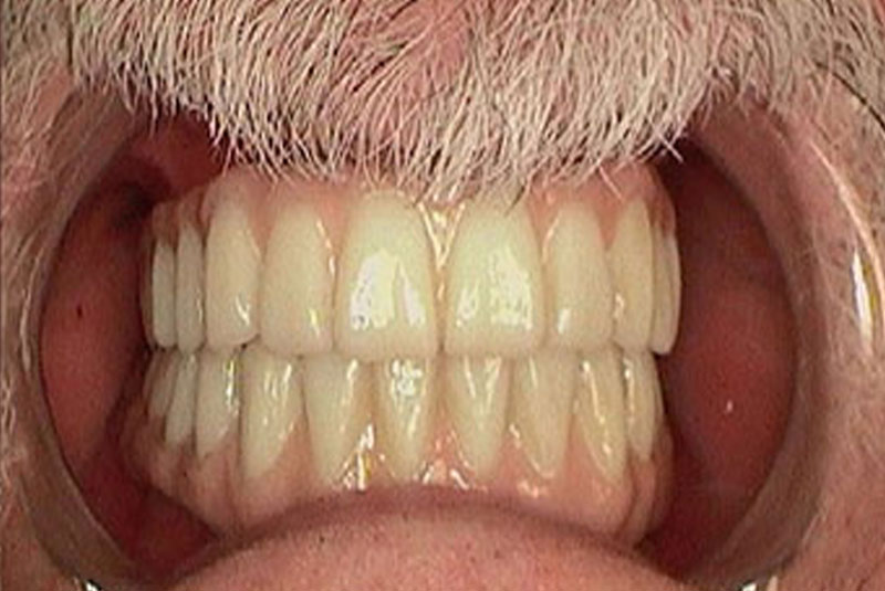 implant after