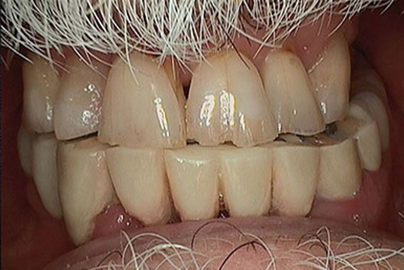 implant before