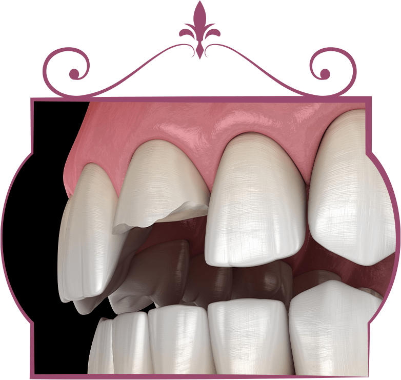 cracked tooth for veneers
