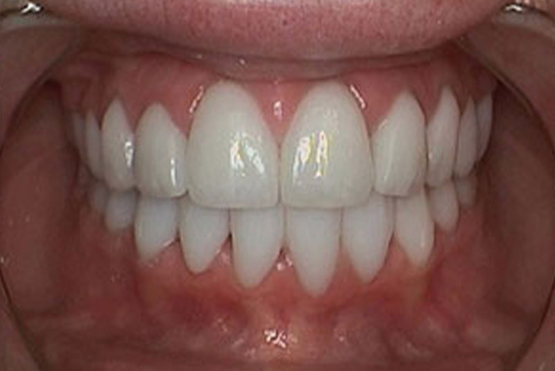 after veneer