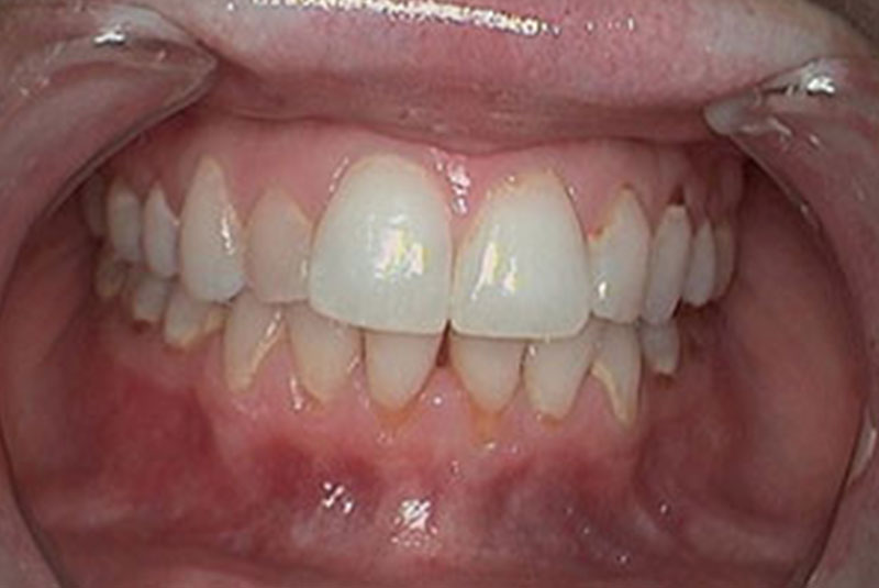 before veneer